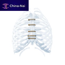 Sternal closure bone cerclage wiring ZIPFIXmetalic monofilament