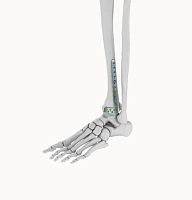 Tibia compression plate ELT010distalanterolaterallocking
