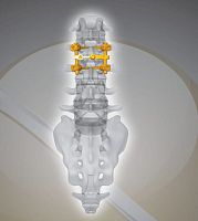 Lumbar osteosynthesis unit NEX D2posterioradult
