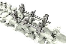 Thoraco-lumbar pedicle screw M9-Iapolyaxialmonoaxialtitanium