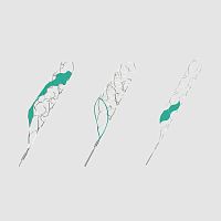 Thrombectomy catheter pRESET seriesneurovascular