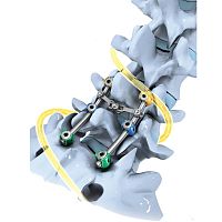 Lumbo-sacral osteosynthesis unit SLICK'S®posterioradult