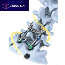 Lumbo-sacral osteosynthesis unit SLICK'S®posterioradult