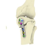 Tibia osteotomy plate TOKAlockingmetallic