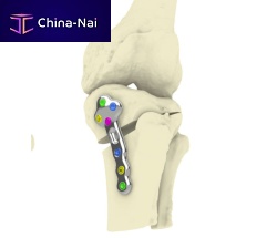 Tibia osteotomy plate TOKAlockingmetallic