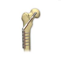 Femoral head compression plate lockingmetallic