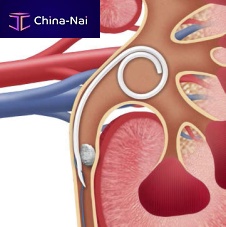 Ureteral stent JFil® nitinol