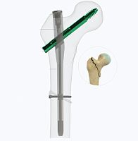 Femoral intramedullary nail proximal fixationmetallic
