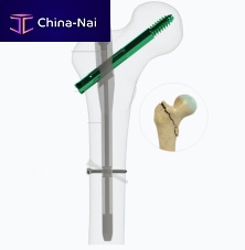 Femoral intramedullary nail proximal fixationmetallic