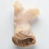 Pulmonary artery vascular bioprosthesis CryoValve® SGallograftwith valve