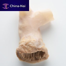 Pulmonary artery vascular bioprosthesis CryoValve® SGallograftwith valve