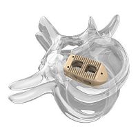 Lumbar interbody fusion cage 4000 seriesposteriorPEEK
