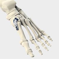 Tarso-metatarsal joint arthrodesis plate LAPIDUSmetallic