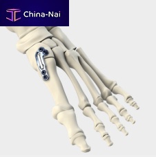 Tarso-metatarsal joint arthrodesis plate LAPIDUSmetallic