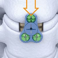 Cervical interbody fusion cage Carmen®lateral