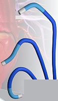 Guiding catheter Tracer cardiac6 FR7 FR