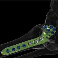 Metatarsophalangeal joint arthrodesis plate ACTIV FUSEanterolateralmetallic