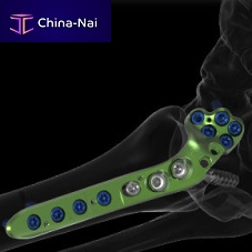 Metatarsophalangeal joint arthrodesis plate ACTIV FUSEanterolateralmetallic