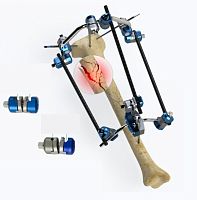 Tibia external fixation system circularadult