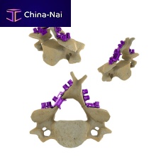 Cervical vertebra laminoplasty plate Blackbird HLSmetallic