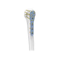 Humerus compression plate PNM1004proximallockingmetallic
