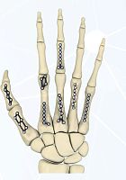 Hand phalange compression plate FRC seriesmetacarpal jointlockingmetallic