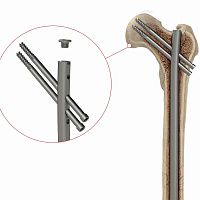 Femoral intramedullary nail 4T1-4001050proximal fixation
