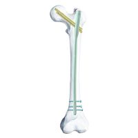Femoral intramedullary nail SGG-K proximal fixationdistal fixationright