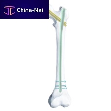 Femoral intramedullary nail SGG-K proximal fixationdistal fixationright