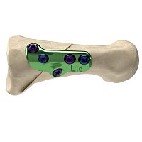 Hallux valgus osteotomy plate Axi+Line®metatarsal boneproximallocking
