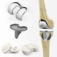 Total knee prosthesis sliding, cruciate-retainingfixed-bearingcemented