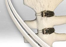 Sternal closure bone cerclage wiring SuperCable® Iso-Elasticmultifilament polymer