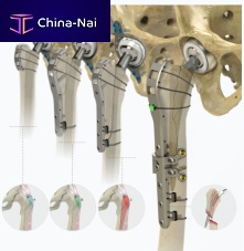 Femur compression plate