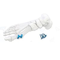 Foot phalange arthrodesis plate 400101x seriestitanium