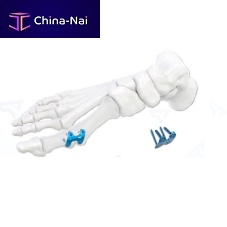 Foot phalange arthrodesis plate 400101x seriestitanium
