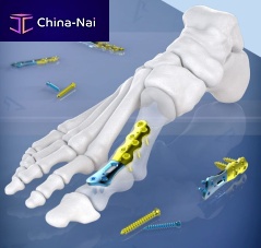 Forefoot compression plate 400120 serieslockingtitanium