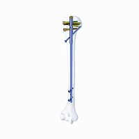Humeral intramedullary nail SHGKproximal fixationmid-shaft fixationright