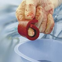 Xenograft bone substitute Cerasorb® Foamfor orthopedic surgerymalleable