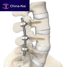 Thoraco-lumbar osteosynthesis unit DIPLOMAT® posterioradult