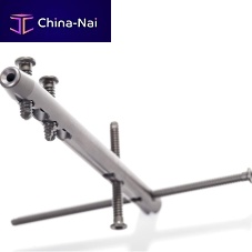 Ankle intramedullary nail OxBridgemid-shaft fixationproximal fixationdistal fixation