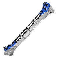 Tibia external fixation system tubularpediatric