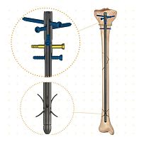 Tibial intramedullary nail Niteproximal fixationdistal fixation