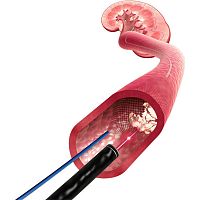 Renal artery stent X-Filternitinol