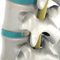 Lumbar disc prosthesis
