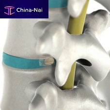 Lumbar disc prosthesis