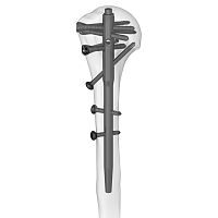 Humeral intramedullary nail 305077 seriesproximal fixationdistal fixationright