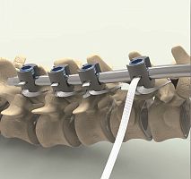 Pediatric posterior spinal fixation band Ortholox® UHMWPE