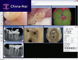 Dental imaging software DBSWIN visualizationdiagnosticdesign