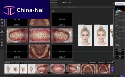 Image editing software Photoalignmedicalfor dental imagingplastic surgery