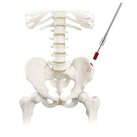 Bone marrow biopsy needle RETRIEVE®